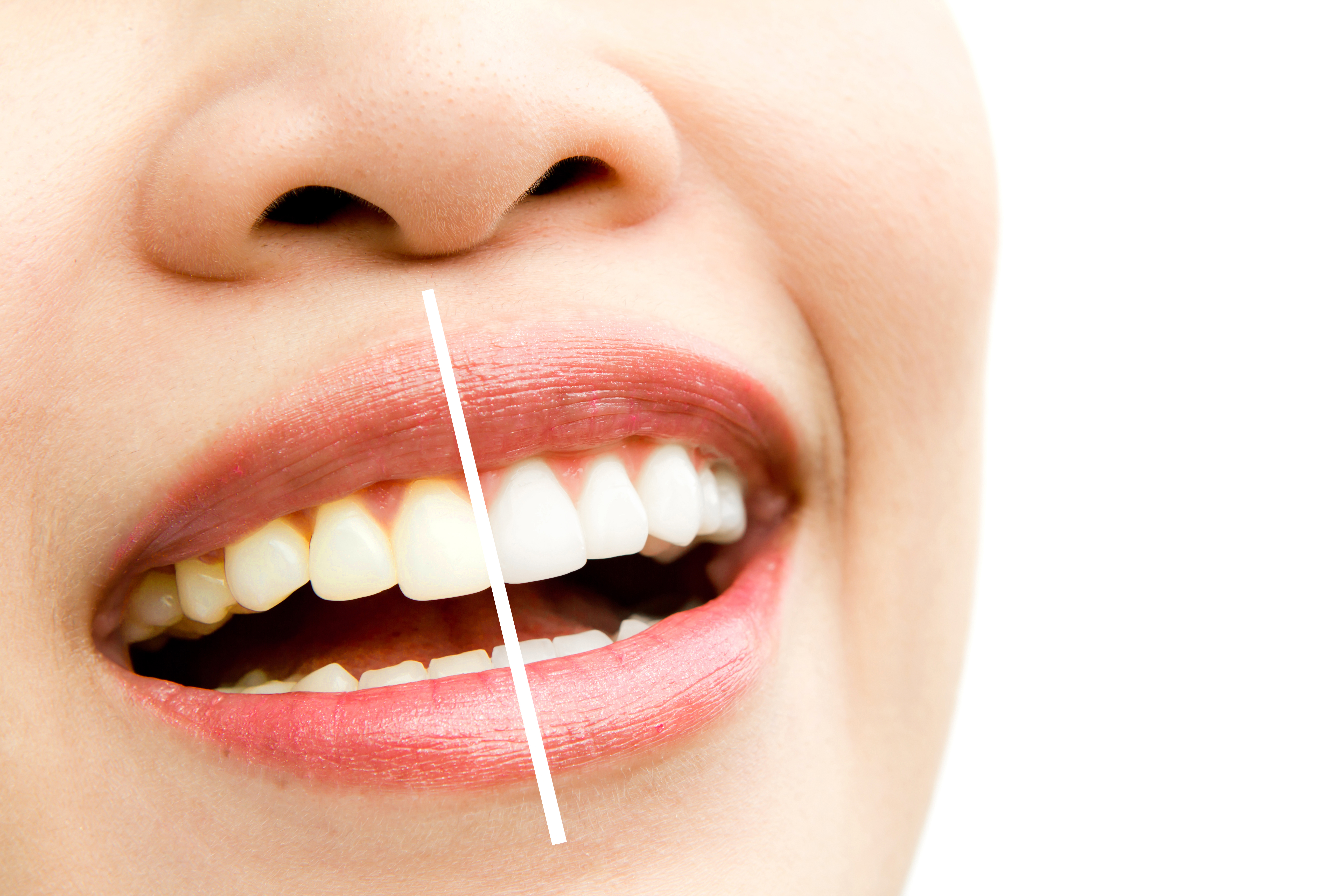 Smile Design Treatment